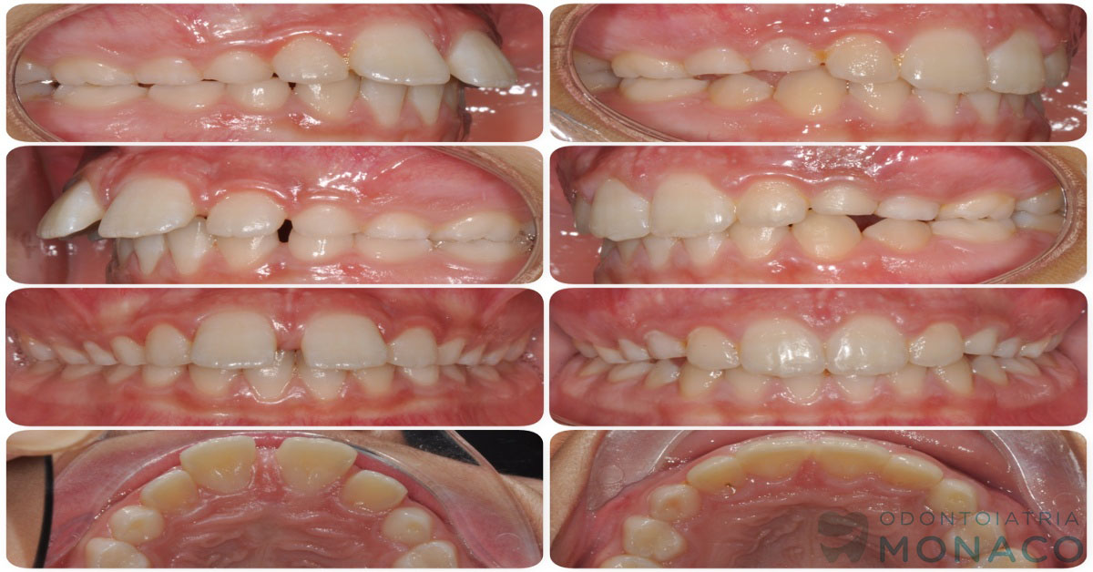 Denti sporgenti - bambino