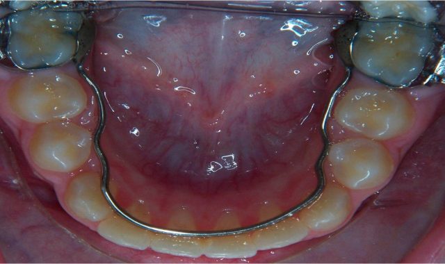 Odontoiatria Monaco - Arco linguale