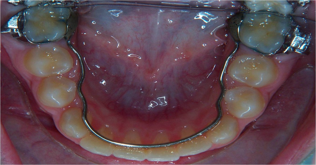 Odontoiatria Monaco - Arco linguale